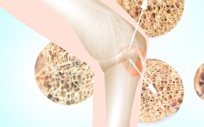 ¿Qué es la osteoporosis y qué podemos hacer?